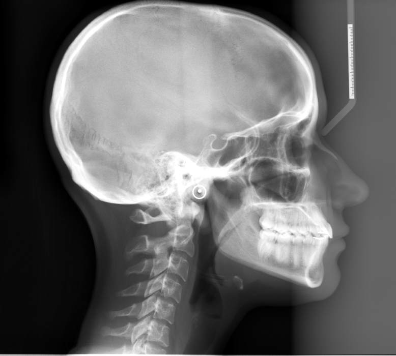 lateral cephalometric skull anatomy maxilla