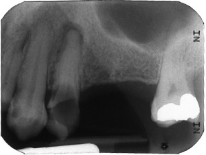 nasolabial fold periapical radiograph left