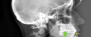 Lateral Cephalometric Skull Anatomy – Part V