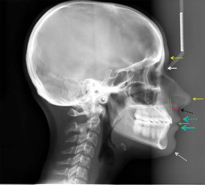lateral skull radiograph soft tissue anatomy with animations