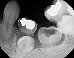 ankylosis primary molars periapical radiograph