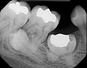 ankylosis primary second molar periapical