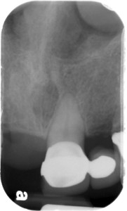 inferior nasal concha periapical radiograph