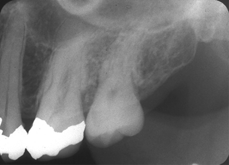 periodontal health - periapical radiograph