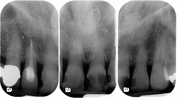 supernumerary teeth maxillary anterior periapical radiographs