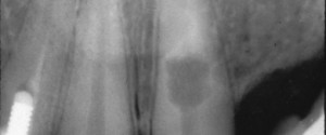 Case of the Week: Internal Resorption treated with endodontic therapy