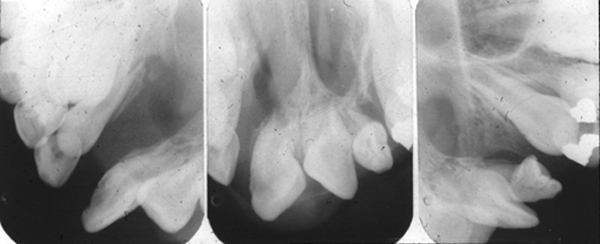 bilateral cleft palate intraoral radiographs