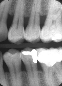 periodontal assessment horizontal bone level bitewing