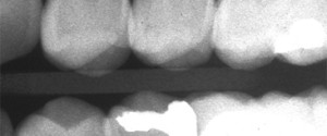 Periodontal radiographic assessment: Horizontal bone loss and Vertical bone defects