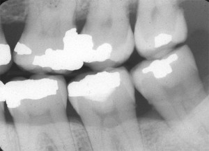 periodontal assessment vertical bone defect