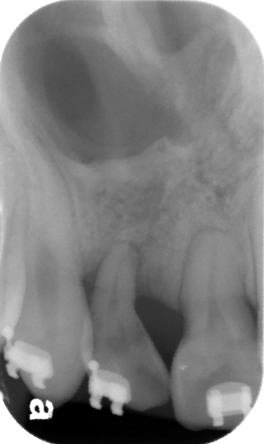 unilateral cleft palate after surgery periapical radiograph