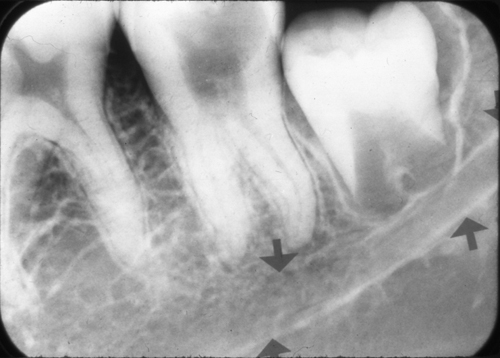 mandibular canal with arrows periapical radiograph