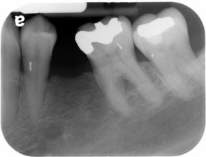 pin mandibular first premolar premolar periapical radiograph