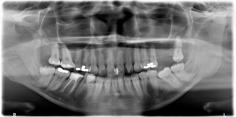 talon cusp maxillary left lateral incisor pantomograph