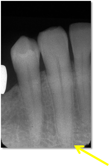 Mandibular canine periapical radiograph. Arrow showing less than 2mm of bone around apex of the tooth.