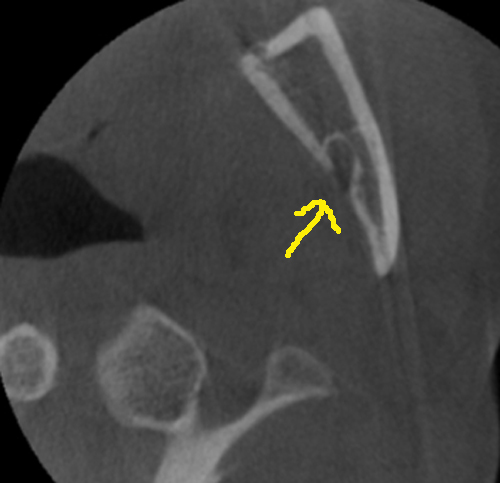 mandibular foramen CBCT axial with arrow