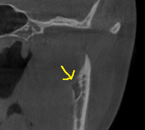 mandibular foramen CBCT coronal with arrow