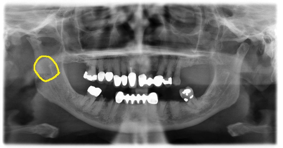 Mandibular foramen: Anatomy and contents