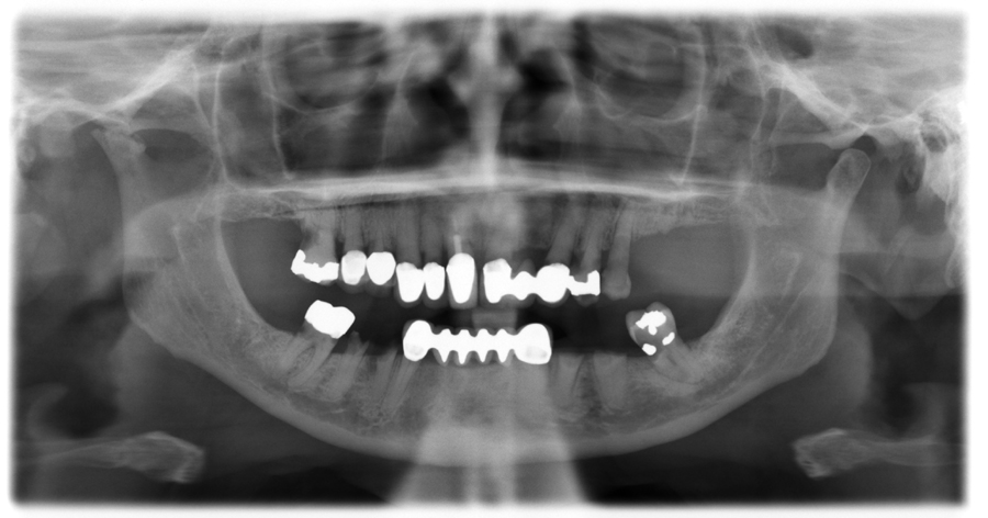 mandibular foramen pantomograph