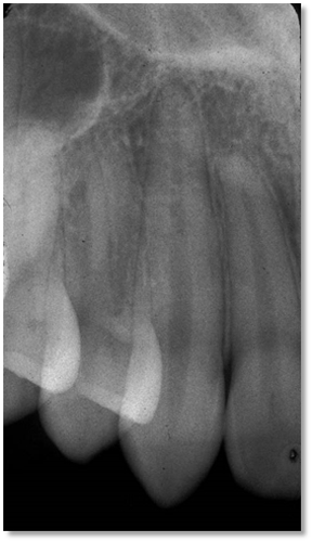 Maxillary canine periapical radiograph showing acceptable overlap of roots between the canine and first premolar.