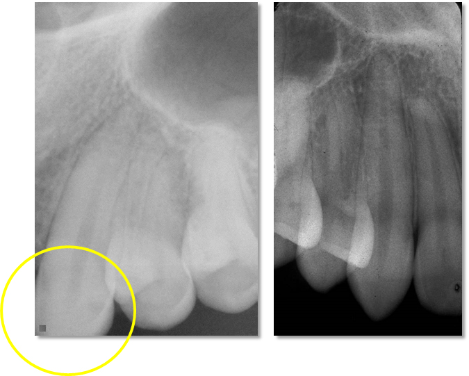 Maxillary canine periapical radiographs. Left - circle noting the crown cut off the radiograph. Right - entire canine is visualized on the radiograph.