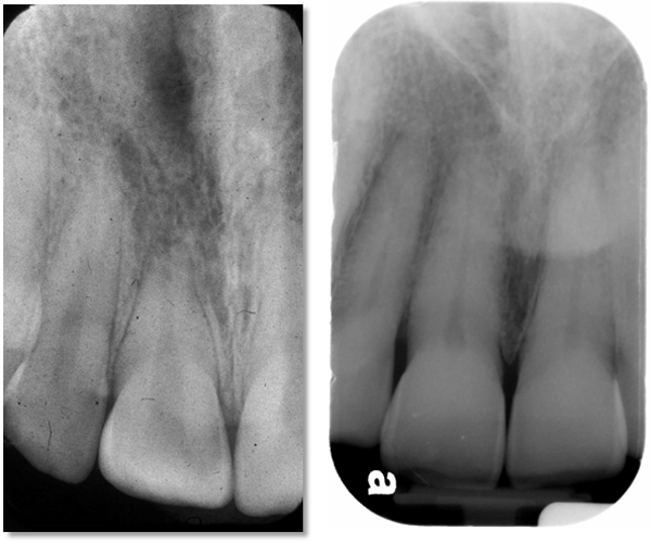 Maxillary central incisors periapical radiographs. Left - note that the root and crown appear to be the same length on the radiograph. Right - note the root appears to be twice the length of the crown which is average for this tooth.