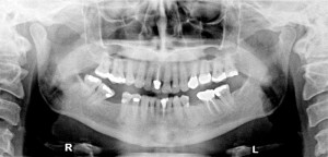 Case of the Week: Palatal Tori – Dr. G's Toothpix