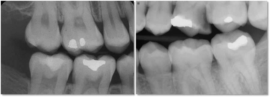 Left - right molar bitewing radiograph showing a minimum of 2 mm of bone height in maxilla and mandible interproximally and 2 mm of bone distal to the second molars. Right - 2 mm of bone not visualized in maxilla.