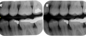 Radiographic Quality Evaluation: Posterior Bitewing Radiographs