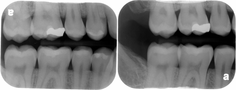Left - severe overlap between maxillary first molar and second molar. Right - minimal overlap (less than 1/2 of enamel) between maxillary first molar and second molar