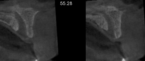incisive foramen CBCT cross-sectional slices