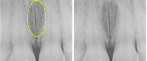 Anatomy Monday: Incisive Foramen