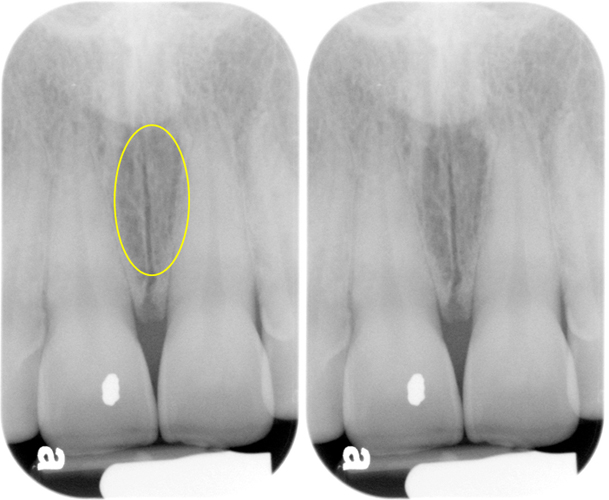 Maxillary central incisors periapical radiograph. Left - yellow circle showing the incisive foramen. Right - incisive foramen as an ovoid radiolucent entity between the maxillary central incisors.