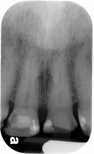 Maxillary central incisors periapical radiograph showing the incisive foramen as a round radiolucent entity between the maxillary central incisors.
