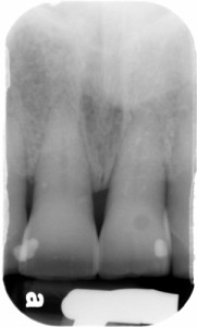 radiolucent area on crown of 9 periapical 1