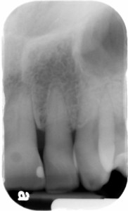 radiolucent area on crown of 9 periapical 2