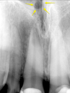 Maxillary central incisors periapical radiograph showing the right superior foramen of the nasopalatine canal (yellow arrows).