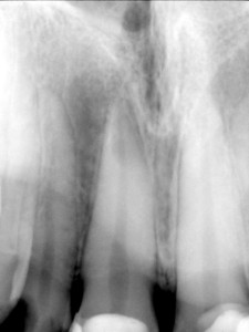 Maxillary central incisors periapical radiograph without arrows.