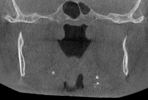 CBCT coronal view - multiple radiopaque entities to the medial of the right and left ramus