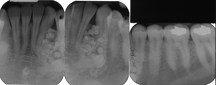 Periapical radiographs - note the multiple well-defined tooth-like structures  in the left anterior mandible.