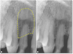 Anatomy Monday Lateral Fossa Incisive Fossa Canine Fossa Dr G S