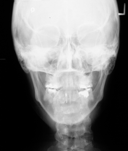 posterioanterior skull radiograph example