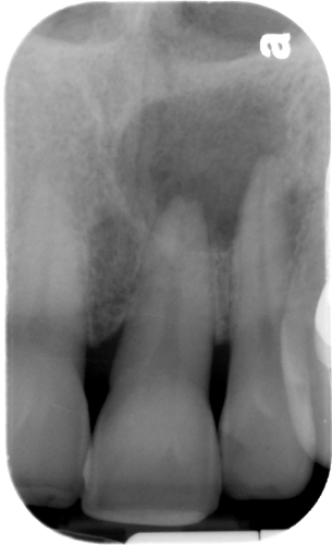 radicular cyst maxillary periapical radiograph