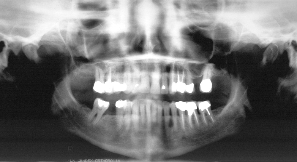 lateral periodontal cyst mandible pantomograph