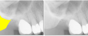 Anatomy Monday: Zygomatic Bone