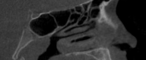 Anatomy Monday: Spheno-Occipital Synchondrosis