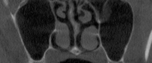 Anatomy Monday: Paradoxic Curvature