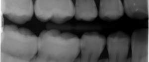 Caries Interpretation: Interproximal Caries Answers