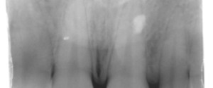 Caries Interpretation: Interproximal Caries Practice