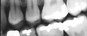 Caries Interpretation: Interproximal Caries